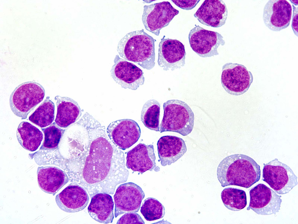Figure 3. Cerebrospinal fluid cytospin showed abundant immature cells.